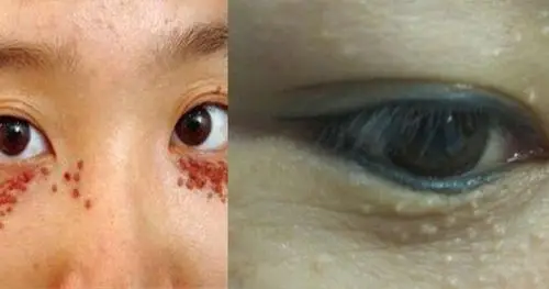 居然是「汗管瘤」作怪!