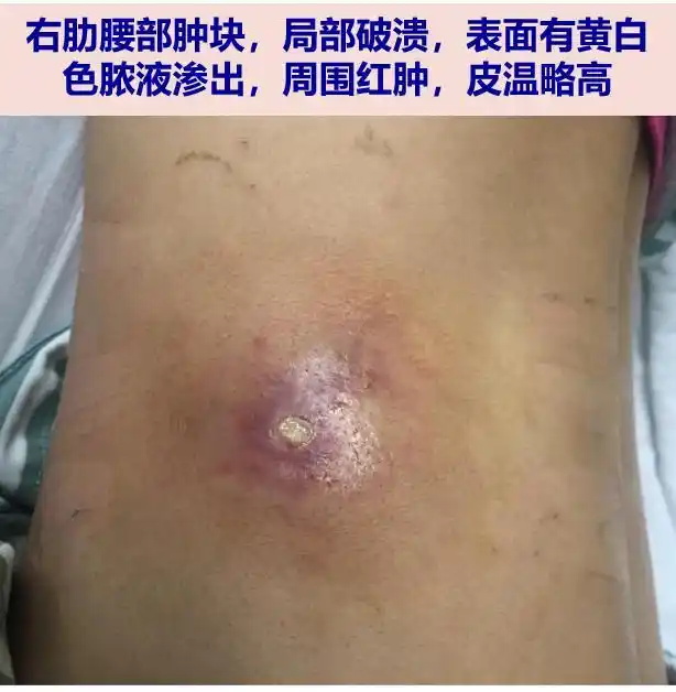 探案丨肺部空洞腰部流脓青年男性何去何从