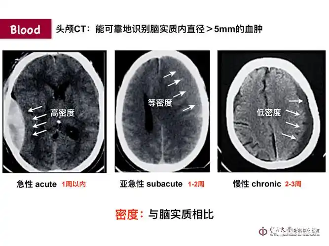 超实用急诊头颅ct3b阅片法
