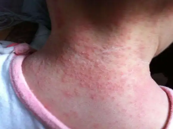 夏季这些常见的皮肤病,妈妈一定要让宝宝远离!