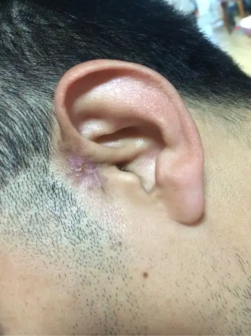 耳前瘘管第二次手术