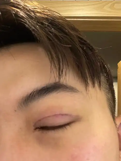 男士双眼皮双眼皮第八天77第九天