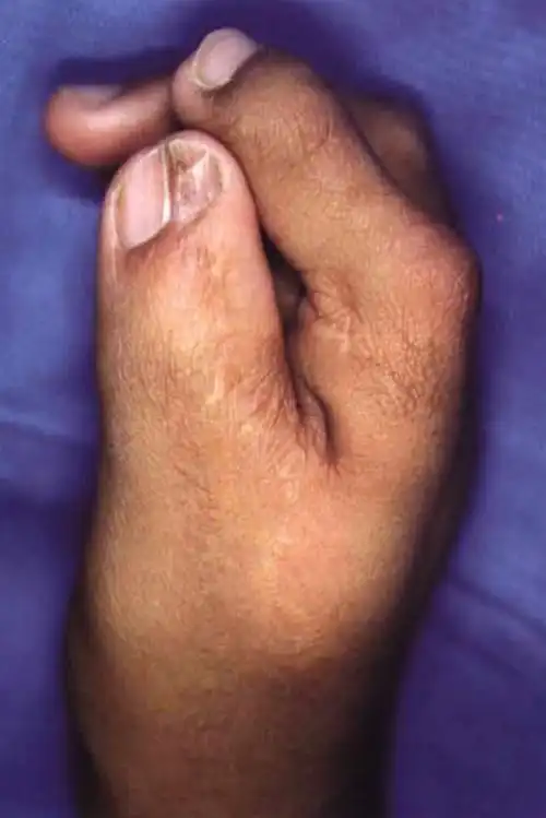 bilhaut-cloquet术后指甲畸形,指间关节僵硬