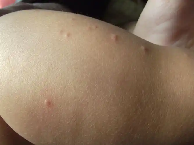 六个月宝宝腿上起小红疙瘩