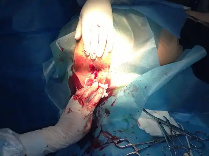 混合痔伴血栓术前术中和术后 - 肛肠外科讨论版 - 爱爱医医学论坛