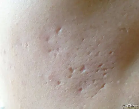 脸上有痘坑怎么办怎么把脸上的痘坑去掉