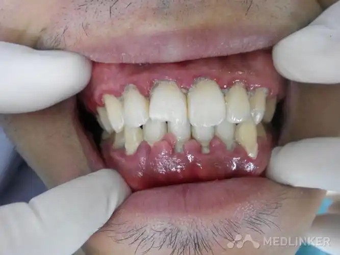 牙周康好还是甲硝唑好_治牙周炎的偏方_牙周炎能治好吗