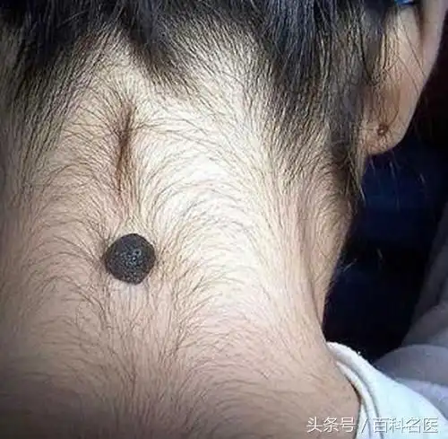 为什么很多人脖子后面都有一颗痣?