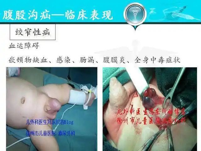 人体腹股沟疝的分型,诊疗