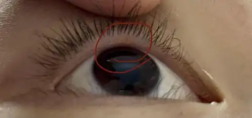 有图慎入 上眼睑发现两个黄色小粒是脂肪粒吗