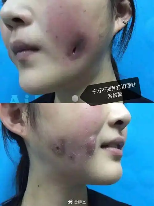 过量?脂肪填充失败怎么办?