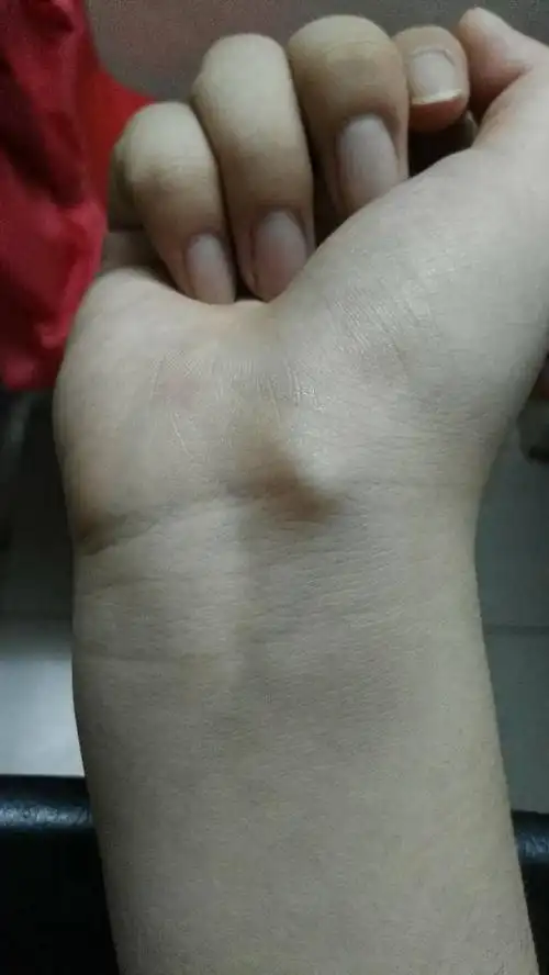 手腕关节突出了一块,最近出现的,刚开始两天按压有点疼,现在没有感