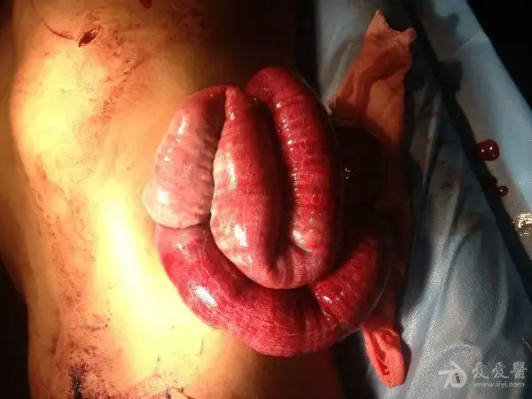 03 11:00:09患者26岁青年男性,因酒醉后斗殴被刀刺伤胸腹部4小时入院