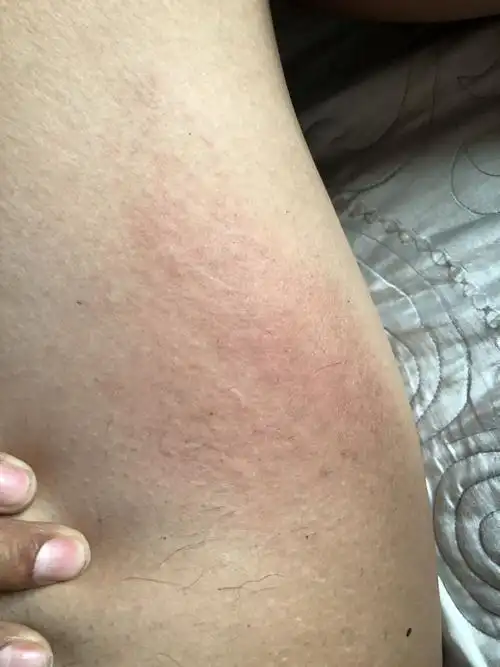 这是什么皮肤癣,痒怎么办,大腿上