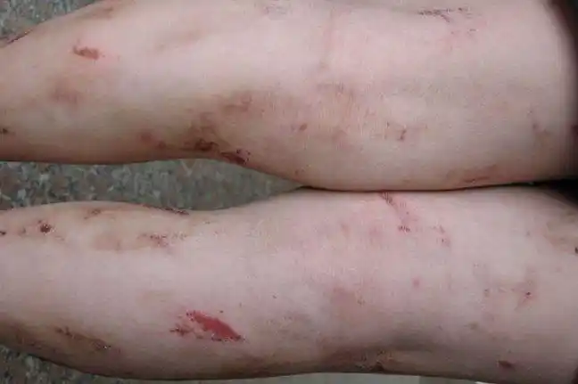 牛皮癣牛皮癣主要表现为红斑,表面覆盖厚层鳞屑分布在全身表面或局部