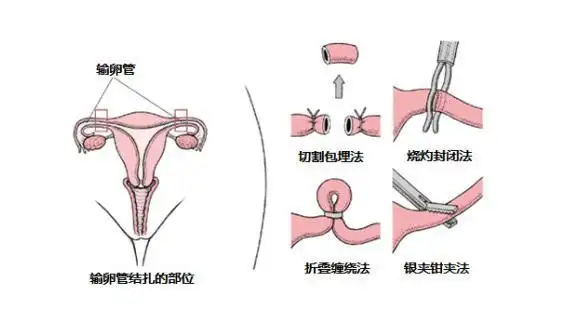 女性结扎后怎么生育