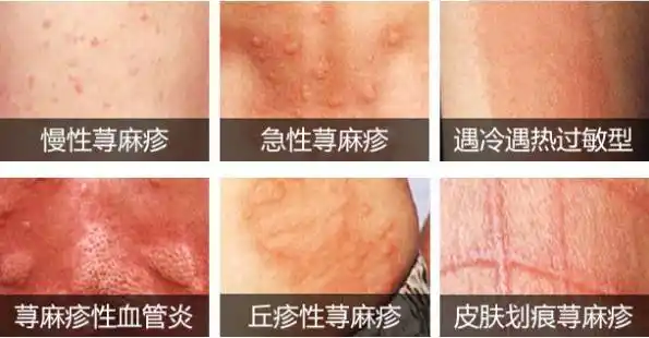 如果养护不当 人们就可能会出现荨麻疹 荨麻疹是一种过敏性皮肤病