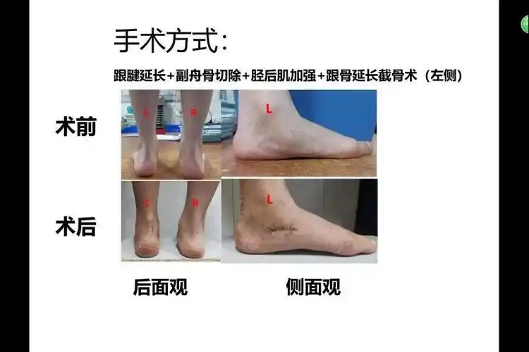 除了矫正鞋康复锻炼最有效治疗平足症的方法在这里