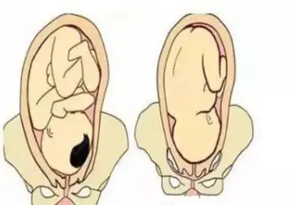 胎儿枕后位是什么意思,图片,胎儿枕后位能顺产吗