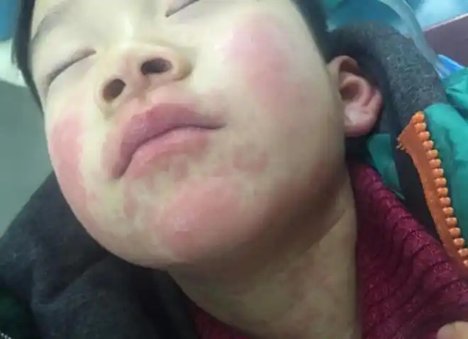 儿子高烧吃药后中毒过敏肾脏负担加重只因爸爸给孩子吃了这种退烧药