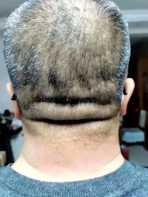 [骷髅][骷髅][骷髅]横纹是脑梗纹,竖纹是脑出血纹,不是危言耸听,遇到