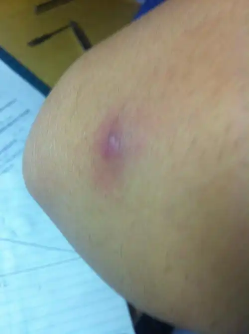 早上发现手肘部分起了一个小包晚上发现变硬了并且发紫挤出