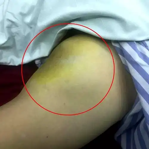 翁女士腿上巨大血肿经询问得知,翁女士在永康一企业上班,7月17日早上