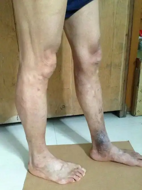 多家医院要求截肢的安徽省阜阳县静脉曲张老烂腿患者治愈三年后特意到