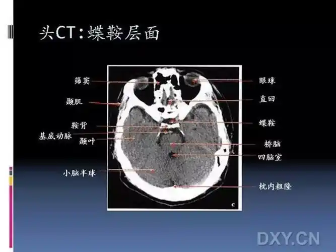 10张图搞定正常头颅ct断层解剖