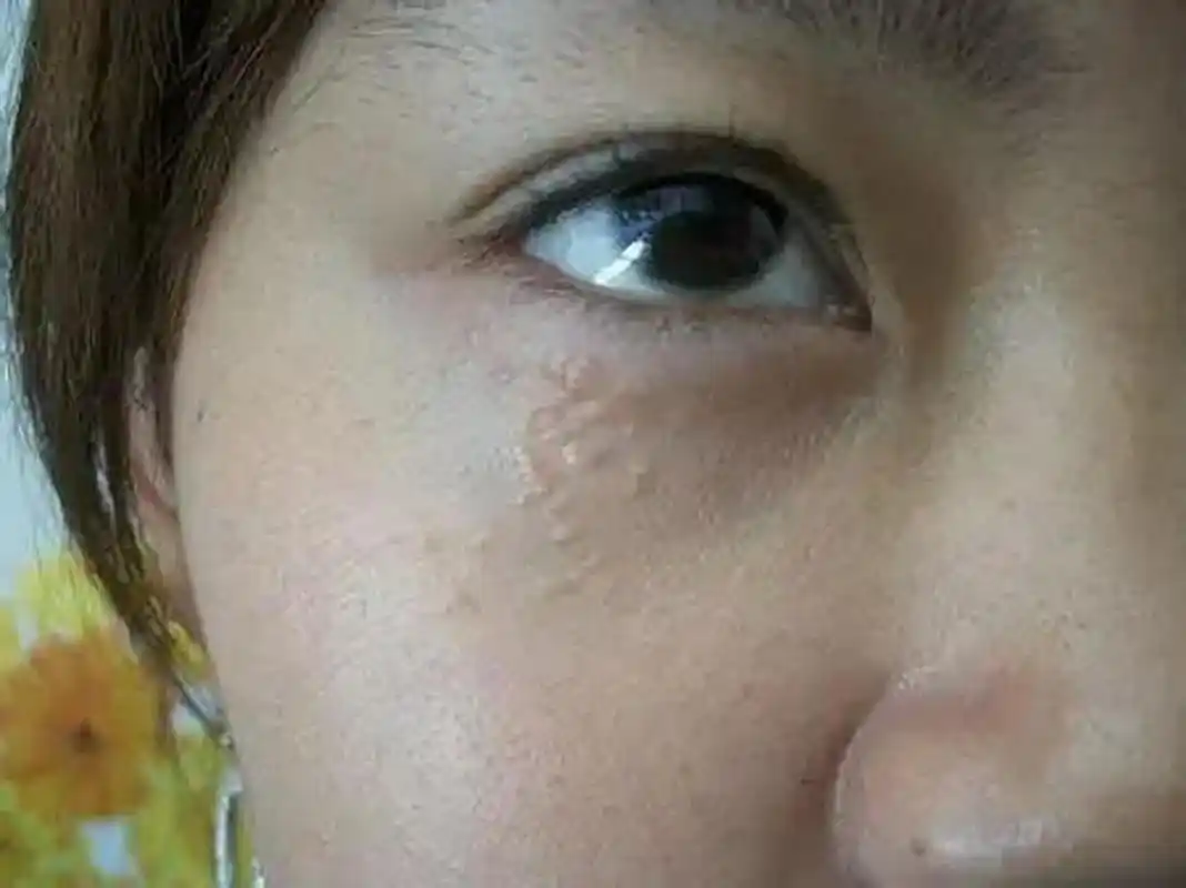 脂肪粒也叫粟丘疹,可以激光,也可以成熟变硬后用针挑,皮肤科治疗室