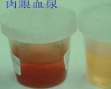 为什么我老有血尿