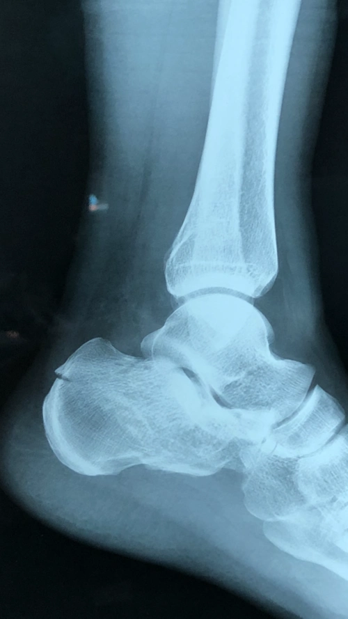 跟骨骨折病例分享 - 好大夫在线