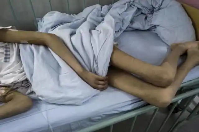 冠军男孩患重症被禁食30天瘦的皮包骨胳膊腿看着就像柴火棍