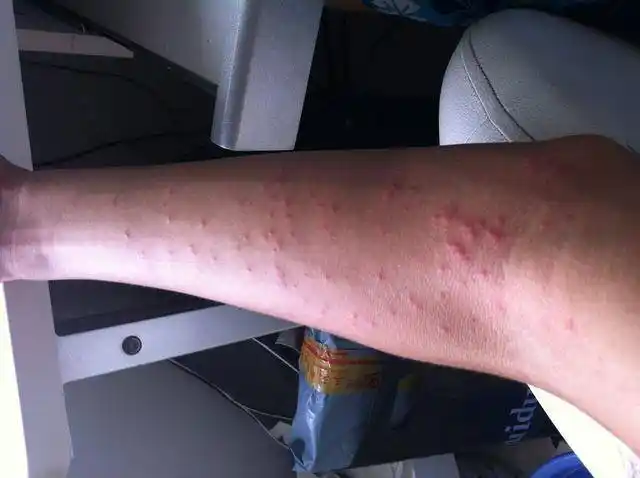 长春肤康医院浅谈:急性荨麻疹与慢性荨麻疹有何区别?_症状