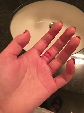 割伤能用水冲吗,请问手指被刀割伤用清水冲可以吗?