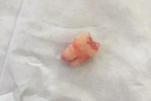 智齿被肉包住了一定要拔吗我来告诉你详细的拔牙过程