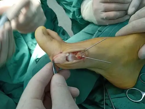 双足拇外翻chevron矫形术