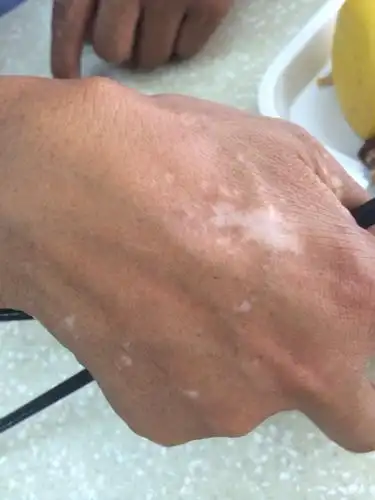 手上身上起的白点,不疼不痒.这是白癜风吗?怎样治疗?给予采取啊加分!