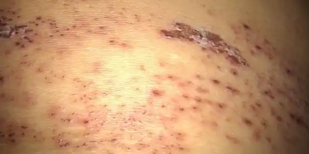 疱疹症状及治疗方法