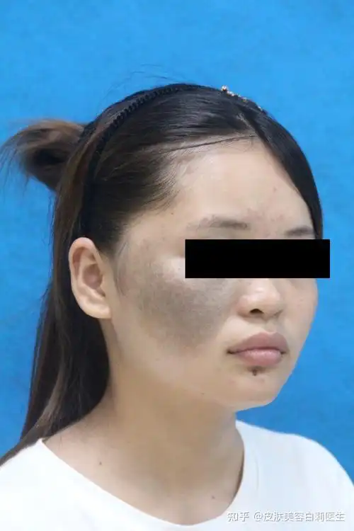 案例05 | 太田痣-激光治疗前,治疗后半年的效果对比图 - 知乎
