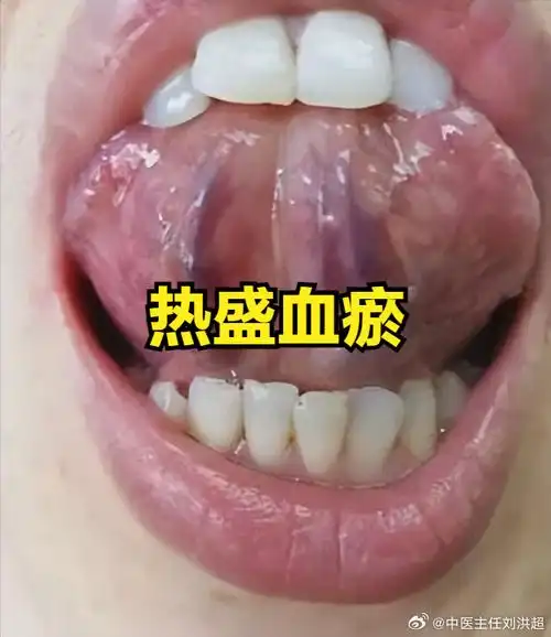 身体是哪种淤,看看舌底就知道    ①:热盛血瘀  舌象:舌下脉络发紫