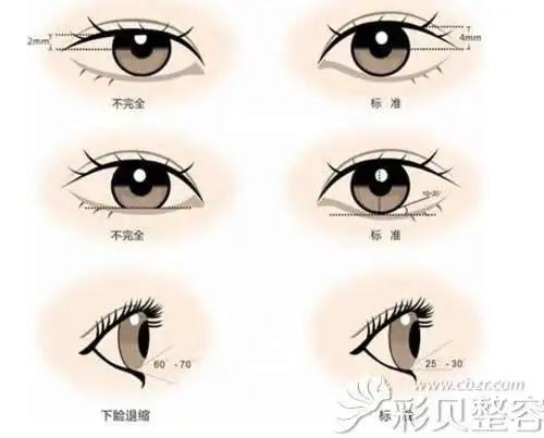 怎样算肿泡眼福州海峡薛克墘展示正常眼睛和肿泡眼图片