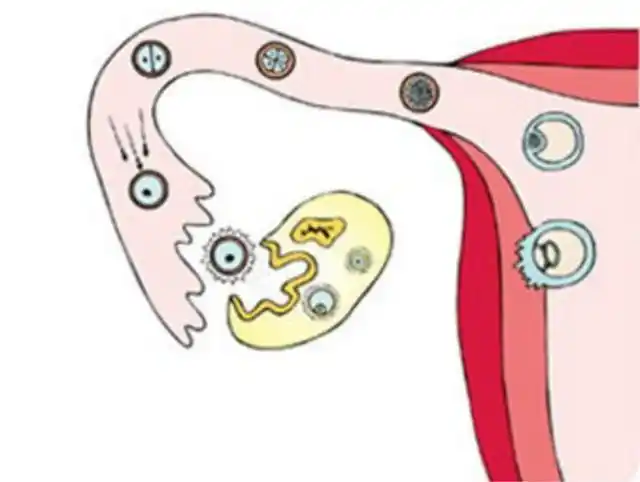 避免了病情进一步恶化,也解除了小汤的痛苦,同时明确了病因:黄体破裂