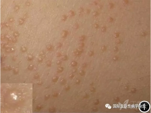 病例挑战:提示:这是一种好发于儿童和青少年的丘疹