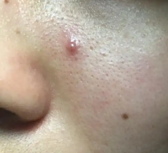 脸又有一颗硬的痘痘快一年了,之前是硬的,没脓,最近长脓了,感觉要