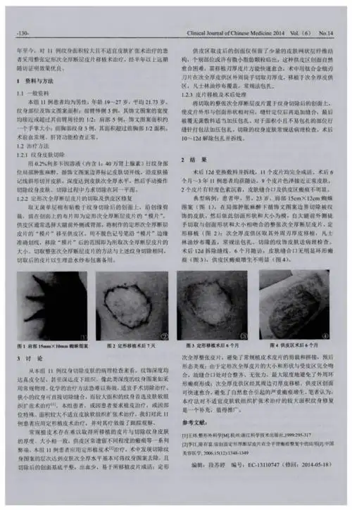 定形植皮术治疗纹身11例.pdf