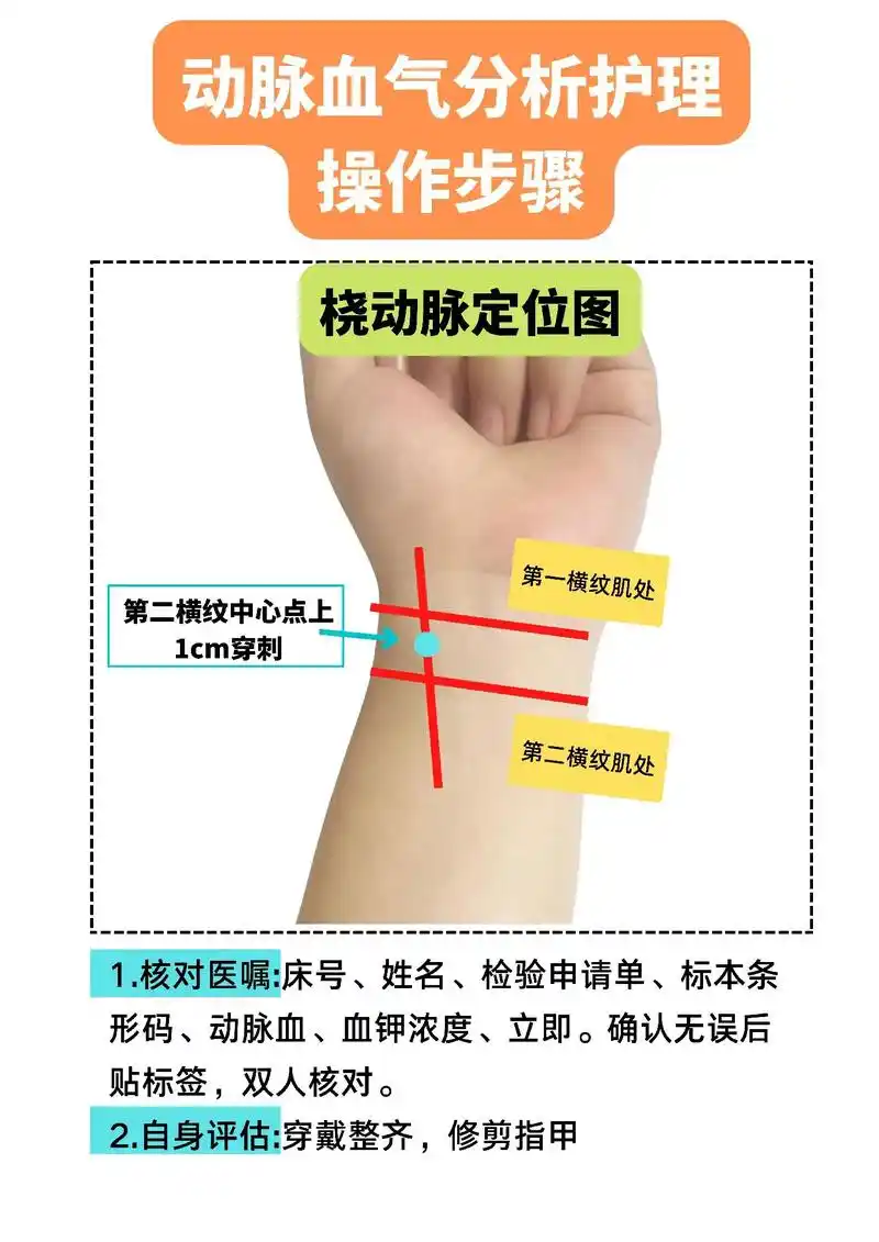 动脉血气分析护理操作.桡动脉采血气#动脉血气 #护士 #护理 - 抖音