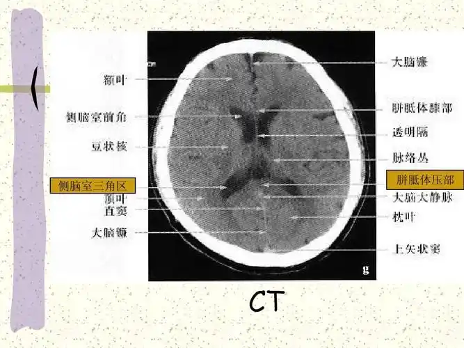 医药卫生 基础医学 颅脑断面解剖ppt 侧脑室三角区 胼胝体压部 ct 第
