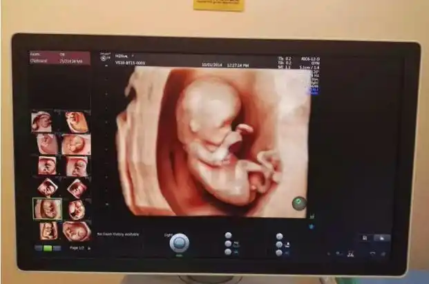 双胞胎四维彩超:揭秘出生前性别差异细节