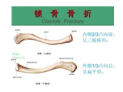 锁骨骨折ppt课件_2.ppt